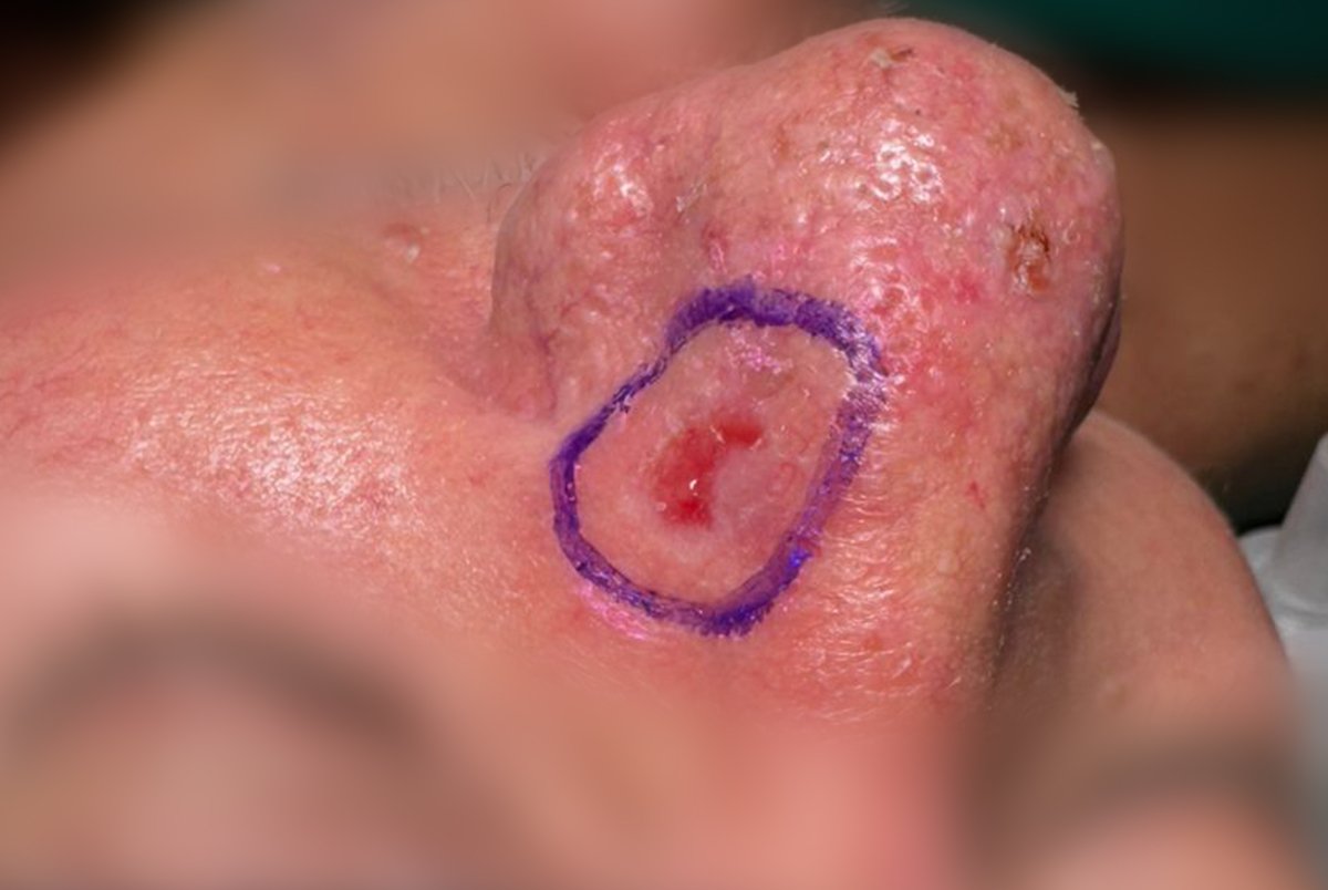 Carcinoma de Células Escamosas da Pele